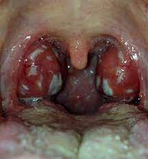 Follicular tonsillitis
