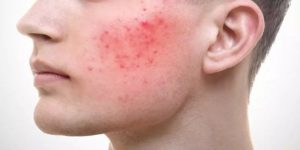 Acne rosacea