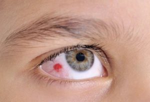 Herpes eruptions on the cornea