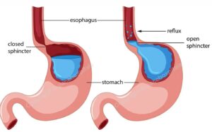 Gastrointestinal reflux disorder (GERD)