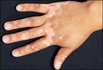 7 Best Homeopathic Medicines for Vitiligo
