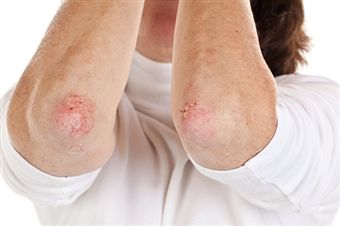 Top 10 Homeopathic Remedies for Shingles