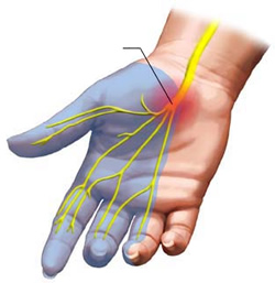 Homeopathic Remedies for Carpal Tunnel Syndrome