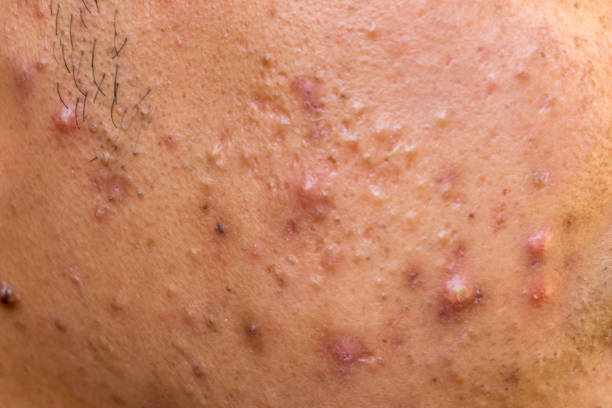 Homeopathic Medicine For Cystic Acne Top 5 Natural Homeopathic Remedies for Cystic Acne