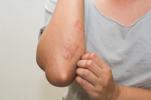 Homeopathic Remedies for Eczema (Skin Rashes and Itching)