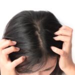 homeopathic remedies for dandruff