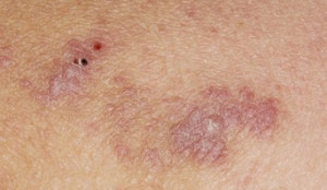 Homeopathic Remedies for lichen Planus