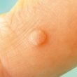homeopathic medicines for HPV