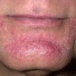 homeopathic medicines for barber's itch