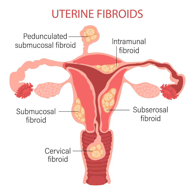 Uterine Fibroids: Homeopathic Medicines Can Save you From Surgery
