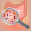 Small Intestinal Bacterial Overgrowth