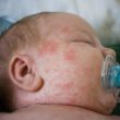 milk allergy homeopathy