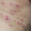 impetigo sores Homeopathy