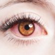 keratitis homeopathy