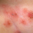homeopathy bullous pemphigoid
