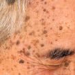 homeopathy seborrheic keratosis
