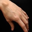 homeopathic medicines for ganglion cyst