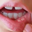 homeopathic medicines for fever blisters