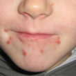 homeopathic treatment for hand,foot and mouth disease