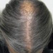 homeopathic medicines for tinea capitis