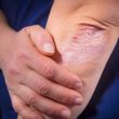 complications of rheumatoid arthritis