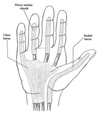 Homeopathic Treatment for Tenosynovitis - Homeopathy at ...
