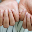 Homeopathic remedies for brittle nails help stimulate and speed up the growth of nails