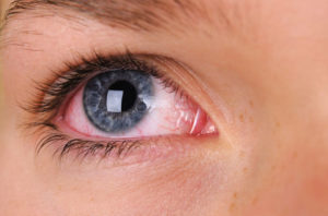 Homeopathic Medicines for Ocular Rosacea