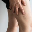 Homeopathic Medicines for Thrombosis