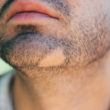 Homeopathic Medicines for Alopecia Barbae