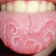 Homeopathic Medicines for Geographic Tongue