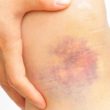 Homeopathic treatment for bruises