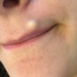 sebaceous cyst