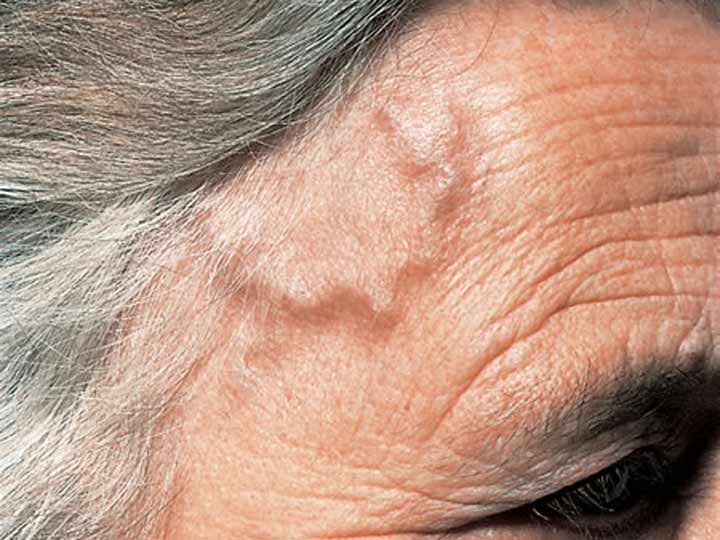Temporal Arteritis : Homeopathic Remedies for Symptomatic Relief
