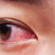 Homeopathic Medicines For Red Eyes