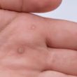 Homeopathic treatment for warts on hands
