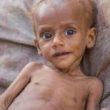 Homeopathic Treatment Of Malnutrition