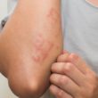 Homeopathy for sarcoidosis