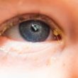 homeopathic remedies for eye discharge