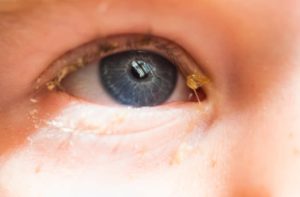 homeopathic remedies for eye discharge 