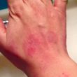 Homeopathic medicines for hookworm infection