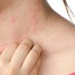 Homeopathic remedies for contact dermatitis