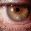 Supportive Role of Homeopathy for Corneal Ulcer