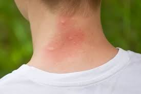 Homeopathic Medicines for Insect Bite
