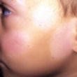 Homeopathic medicines for pityriasis alba