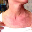 Polymyositis