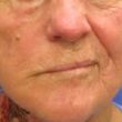 Homeopathic medicines for Ramsay Hunt Syndrome