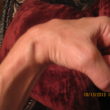 Homeopathic treatment for exostosis