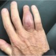 Osteomyelitis