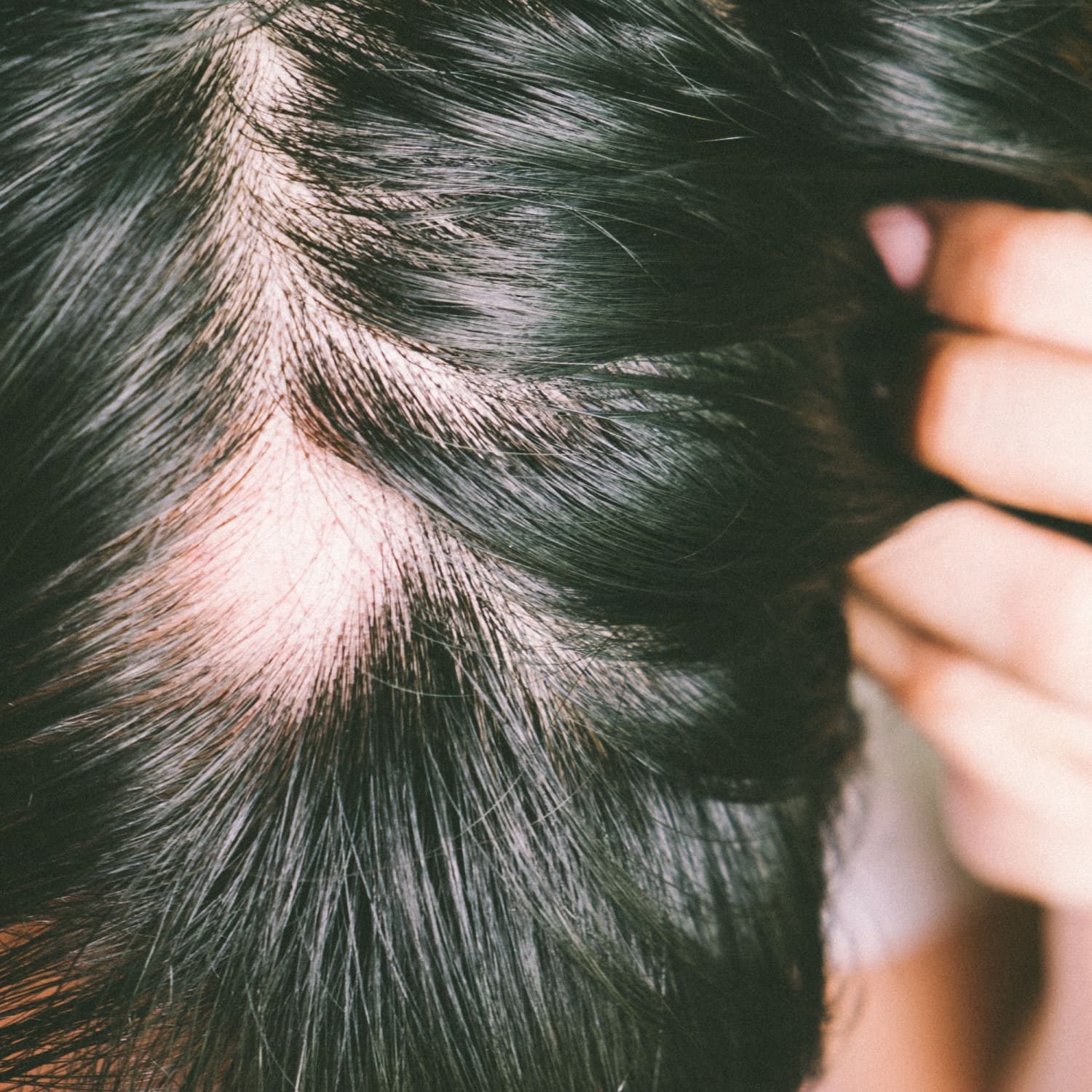 Homeopathic treatment for Alopecia Areata and Bald patches